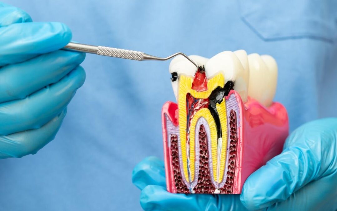 Eating and Drinking After a Root Canal: What You Should Know