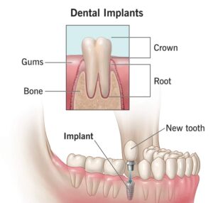 Dental Implants