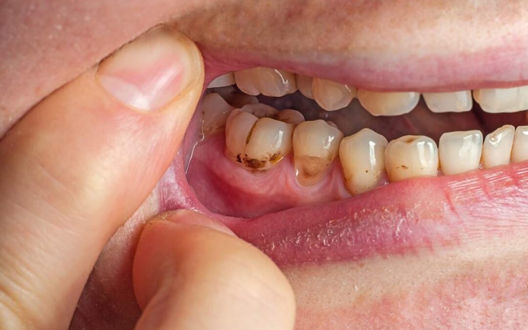 Sugar and Cavities: What Your Dentist Wants You to Know (And How We Can Help)