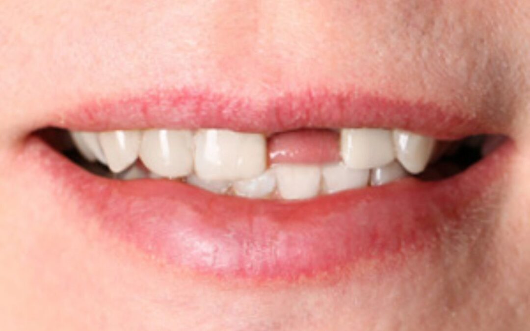 Top Methods for Replacing a Missing Tooth for Gilbert Patients: Dental Implants, Bridges, or Dentures?
