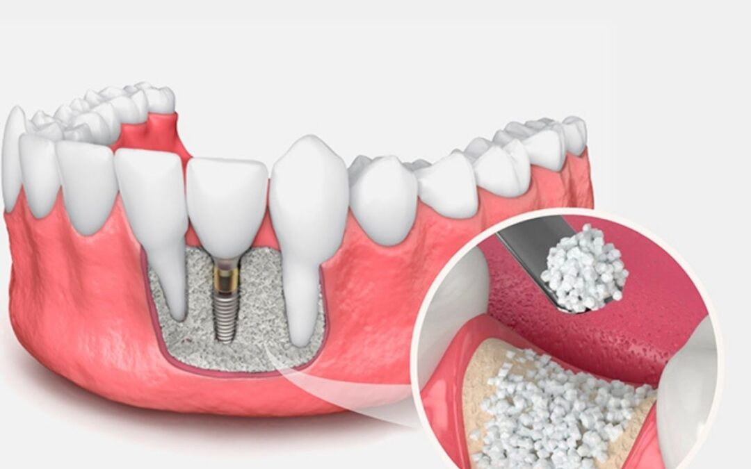 Bone Grafting: A Key Step to Restoring Your Smile and Preparing for Dental Implants