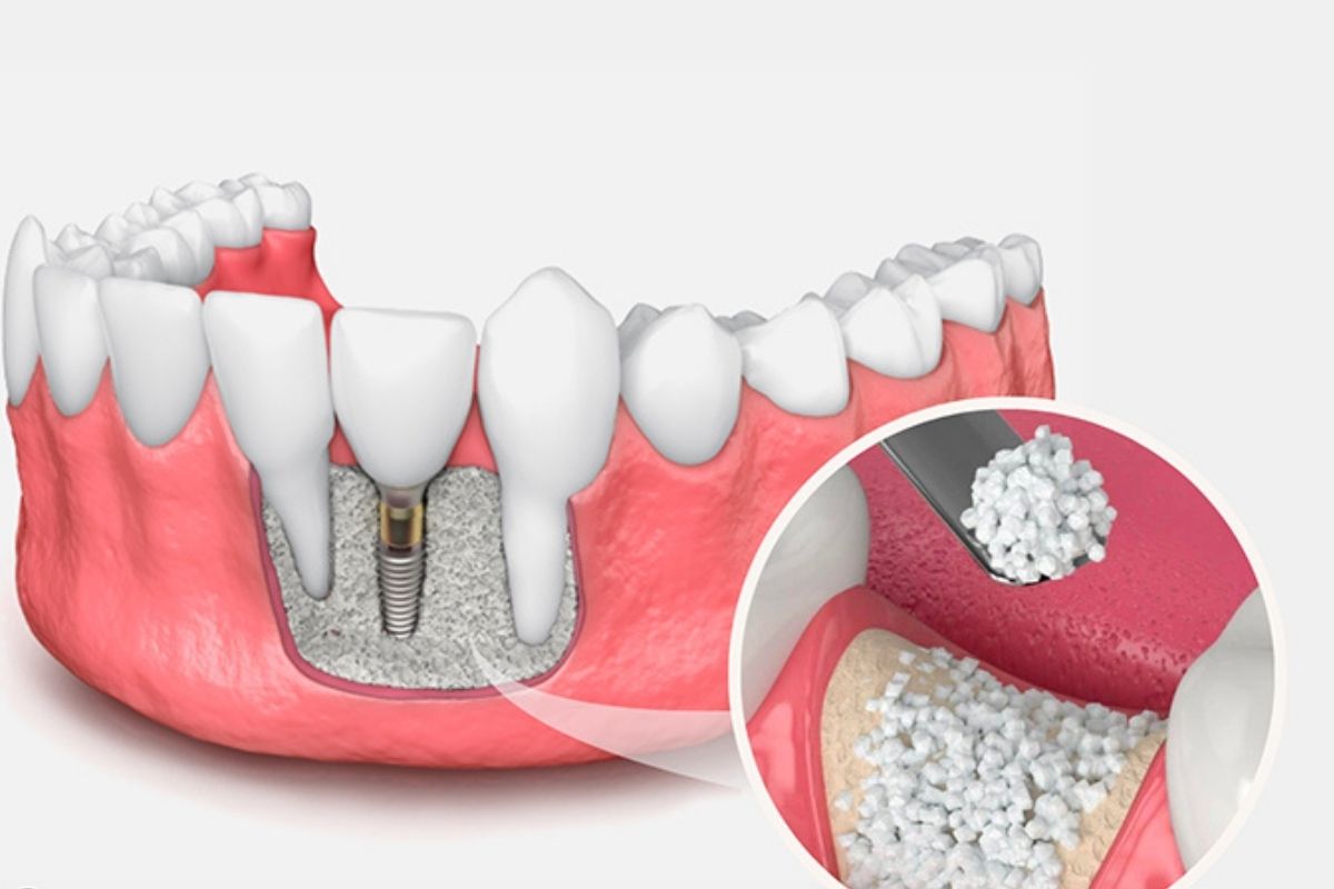 Bone Grafting Before Dental Implants Bone grafting strengthens the jaw and prepares your mouth for dental implants