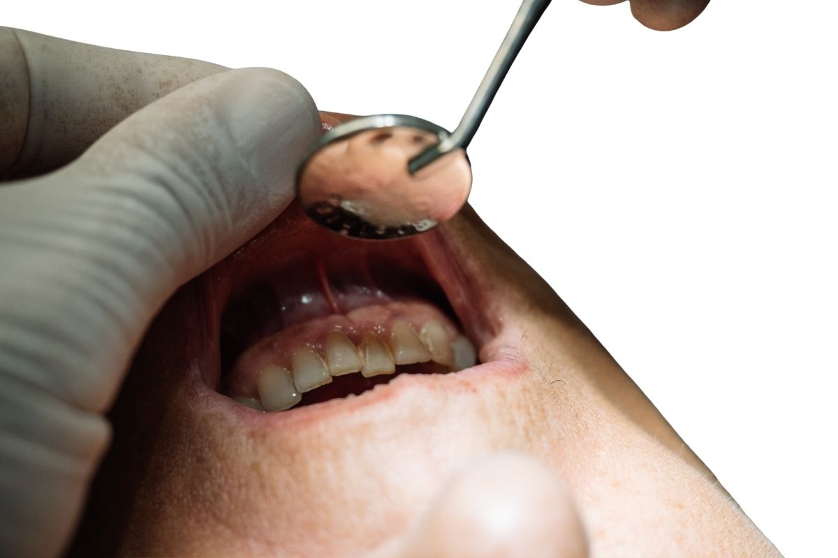 Prevent Cavities Naturally – Dentist Advice Dentist-Approved Ways to Stop Cavities Before They Start