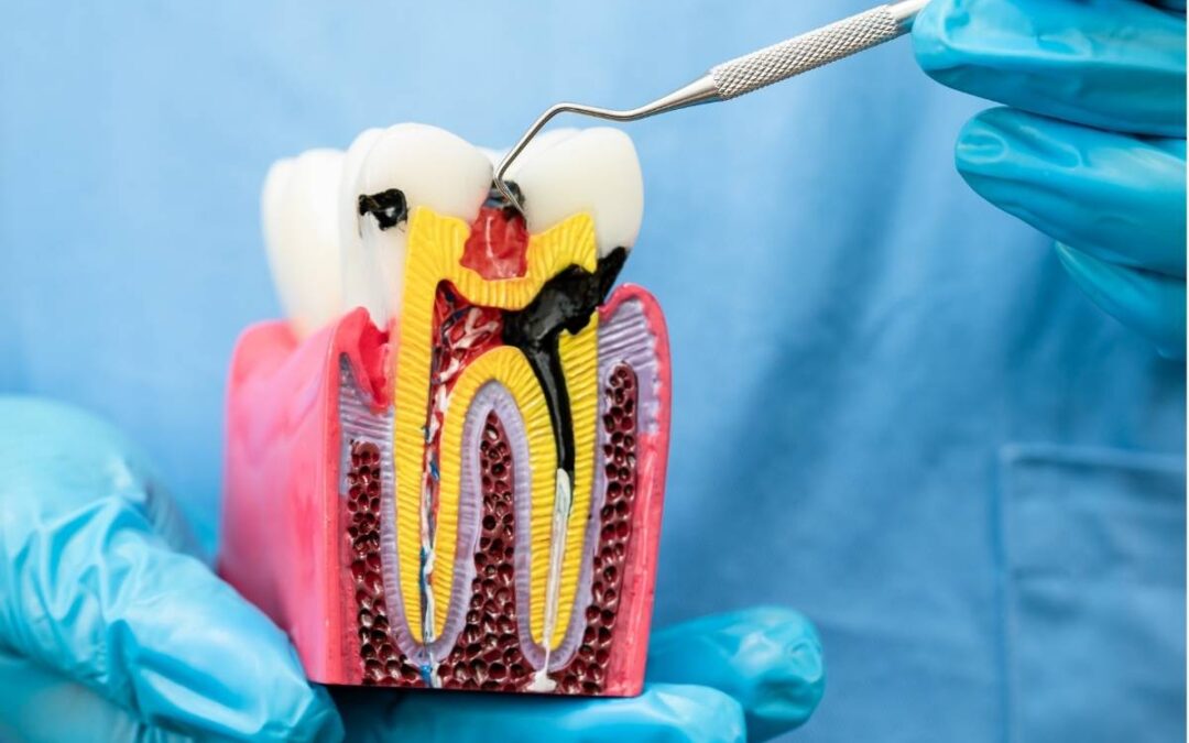 8 Warning Signs You Might Need a Root Canal