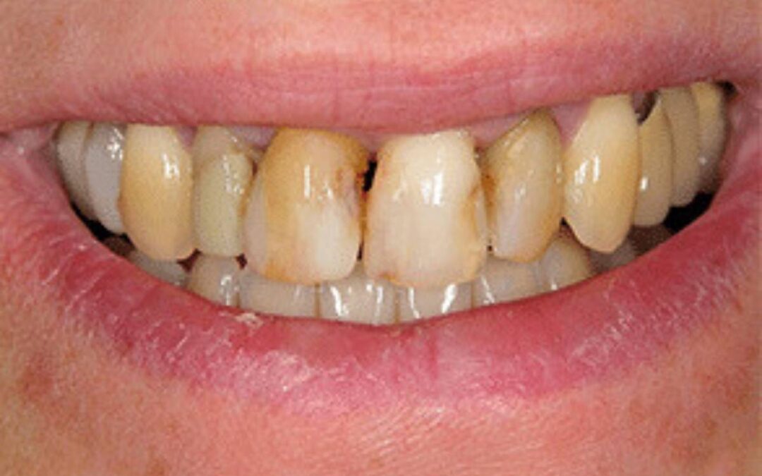 What Causes Facial Swelling from a Tooth Infection?