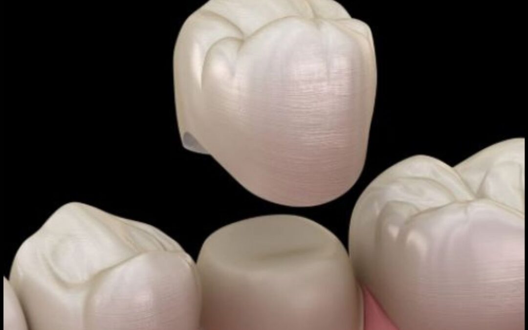 Are Same-Day Crowns Durable? Long-Term Benefits for Gilbert Patients