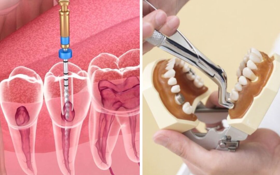 Root Canal vs Tooth Extraction: What Gilbert Patients Should Know Before Deciding