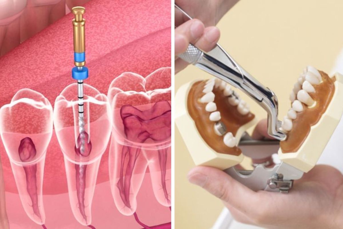 Root canal procedure and tooth extraction comparison showing dental treatment options for Queen Creek patients.