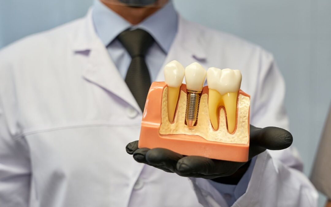 Can You Get Dental Implants If You Smoke? A Dentist Explains